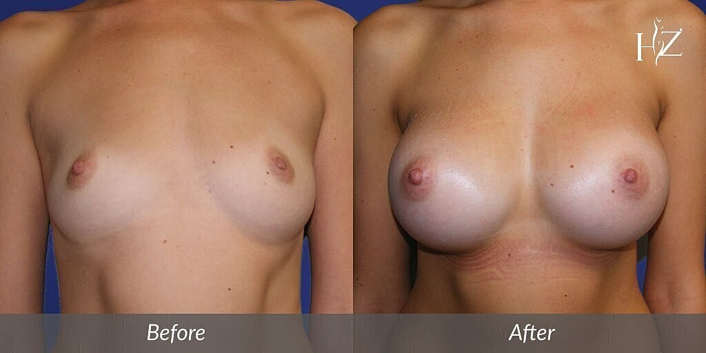 breast augmentation before and after 2
