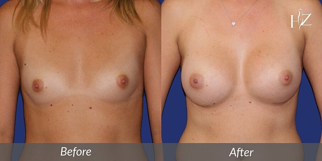 breast augmentation before and after, breast augmentation orlando, boob job before and after, boob job orlando