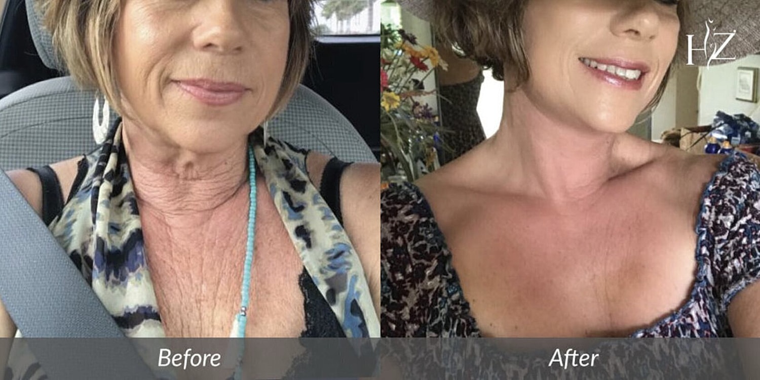 neck lift before and after 1