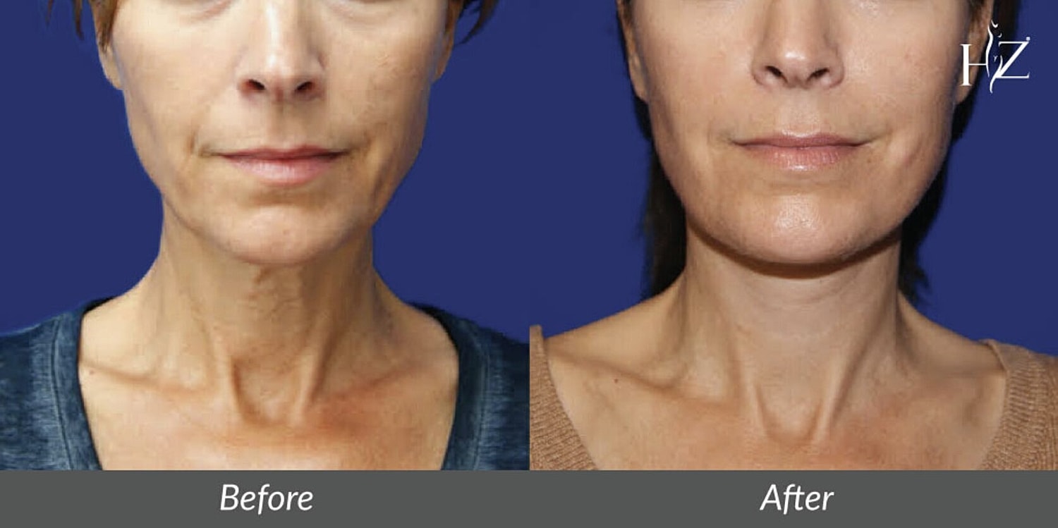 neck lift before and after 4