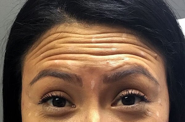 botox patient before 1