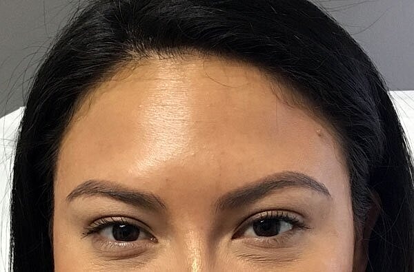 botox patient after 1
