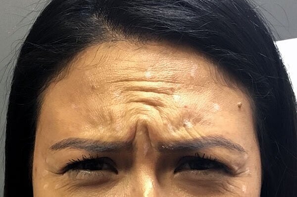 botox patient before 2