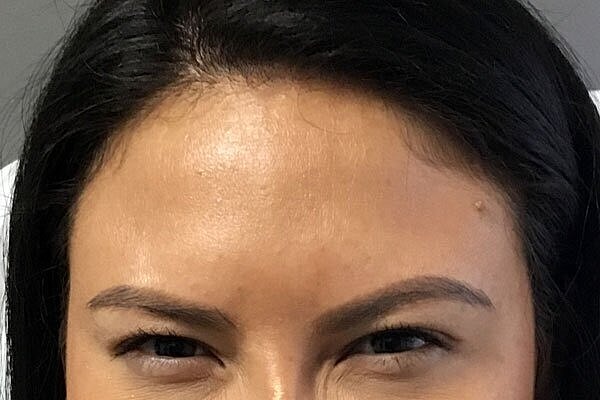 botox patient after 2