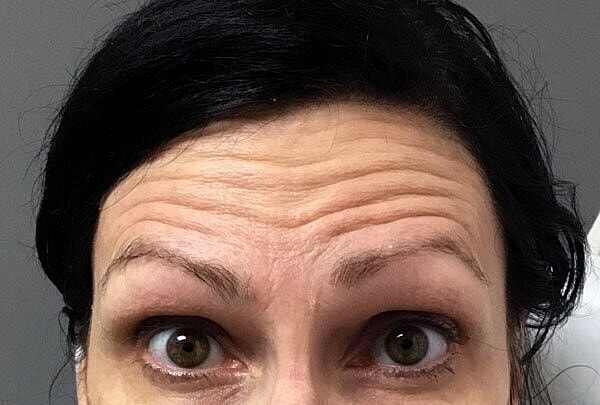 dysport patient 1 before pic