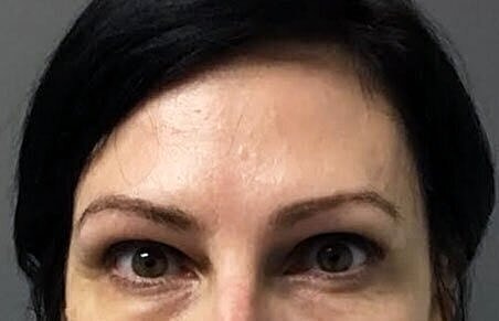 dysport patient 1 after pic