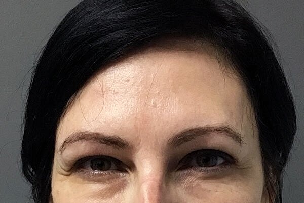 dyport patient 2 after pic