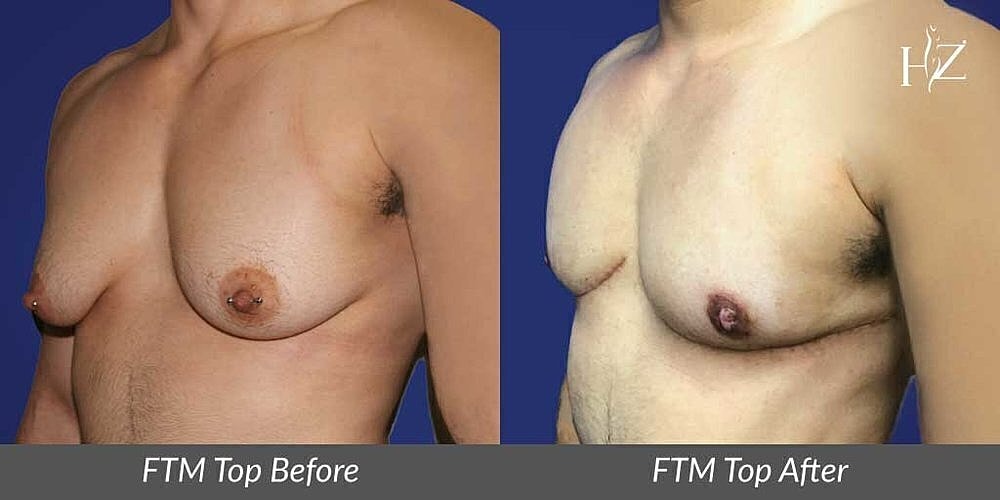 ftm top surgery patient before and after 1