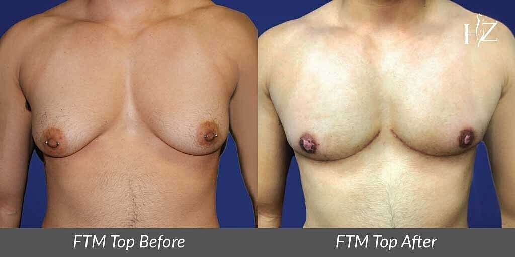 ftm top surgery patient before and after 3