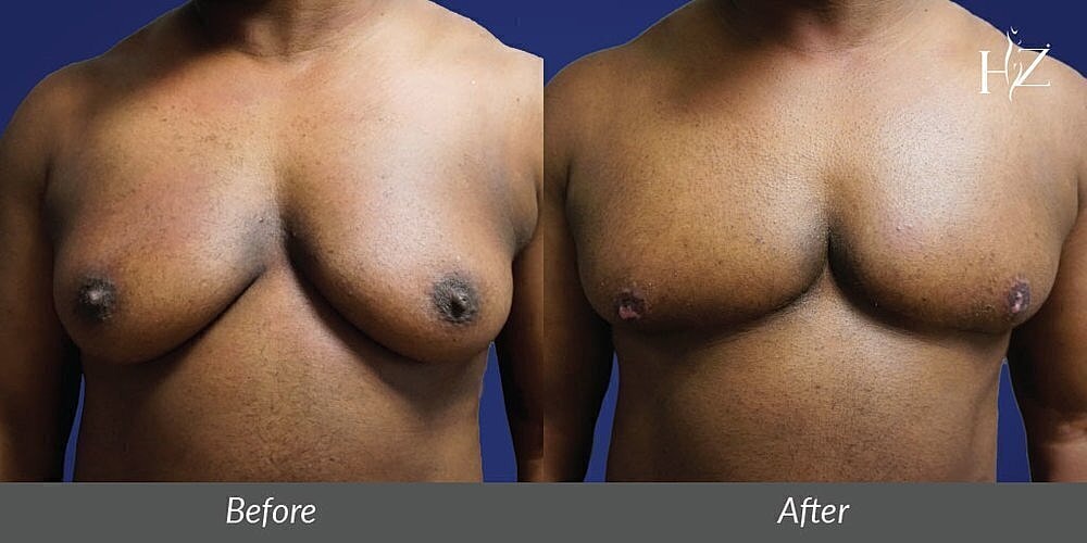 ftm top surgery patient before and after 3
