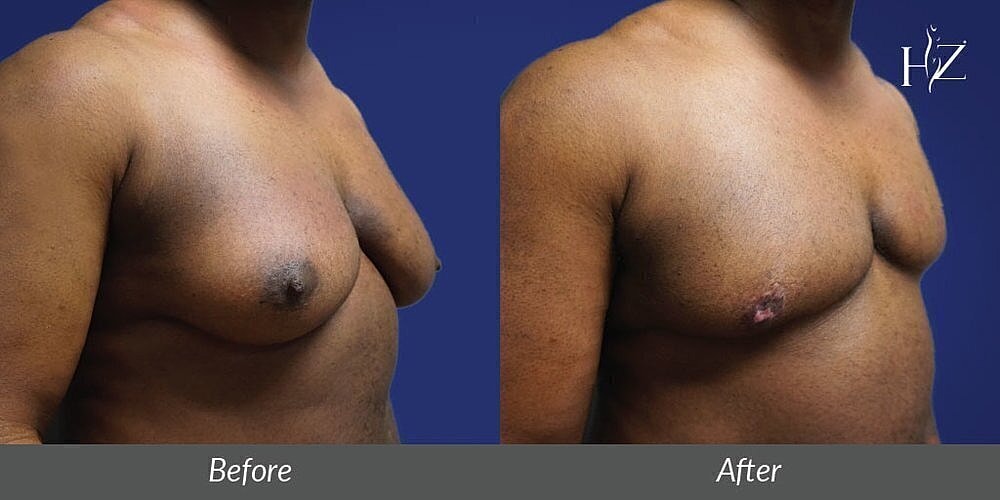 ftm top surgery patient before and after 4
