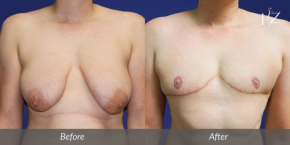 ftm top surgery patient before and after 5