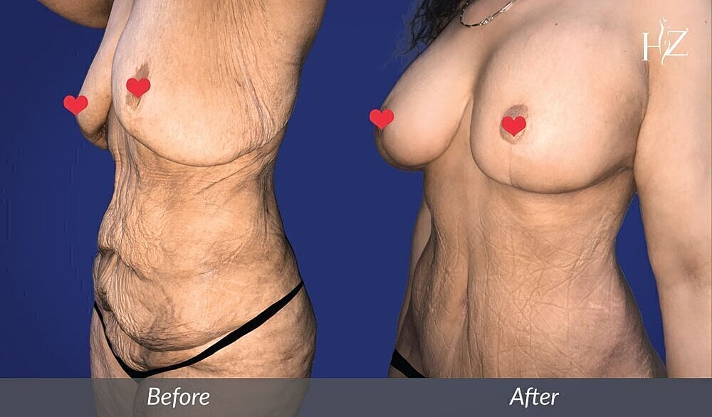 alt="mommy makeover patient before and after 1"