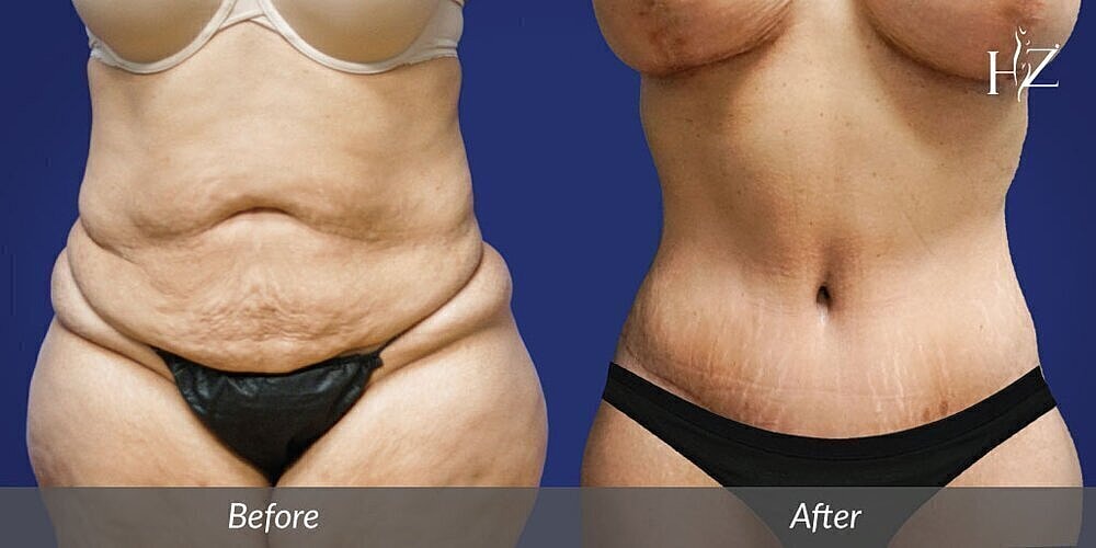 mommy makeover patient before and after 2