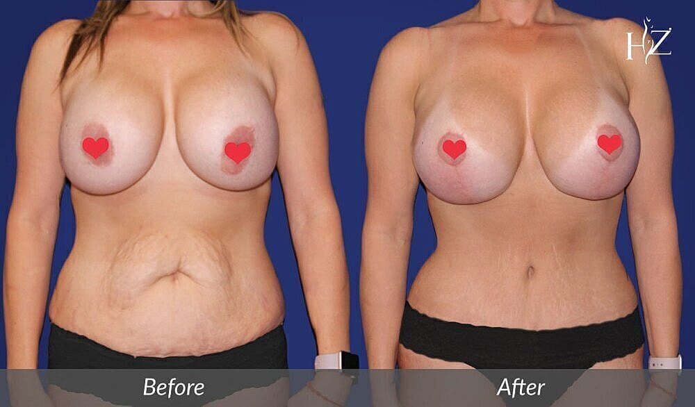 mommy makeover patient before and after 3