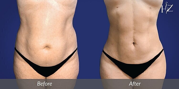 liposuction patient before and after 1