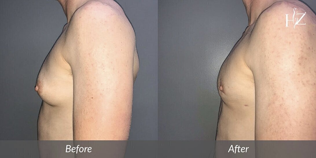 gynecomastia treatment patient before and after 2
