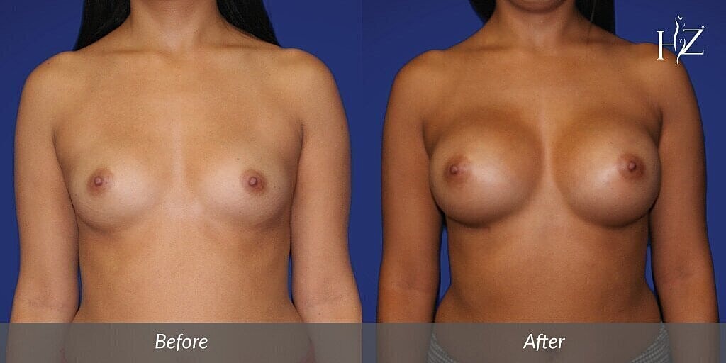 breast augmentation patient before and after 1