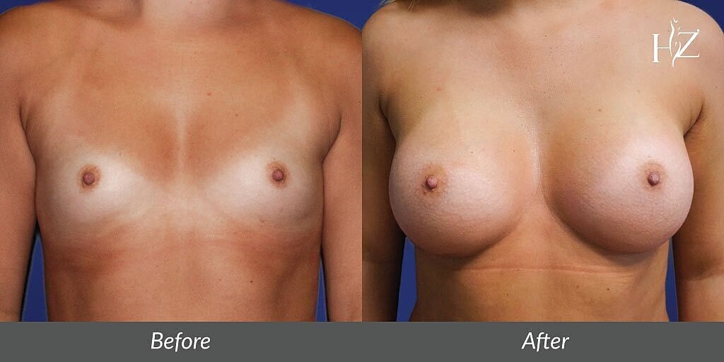 breast augmentation patient before and after 2