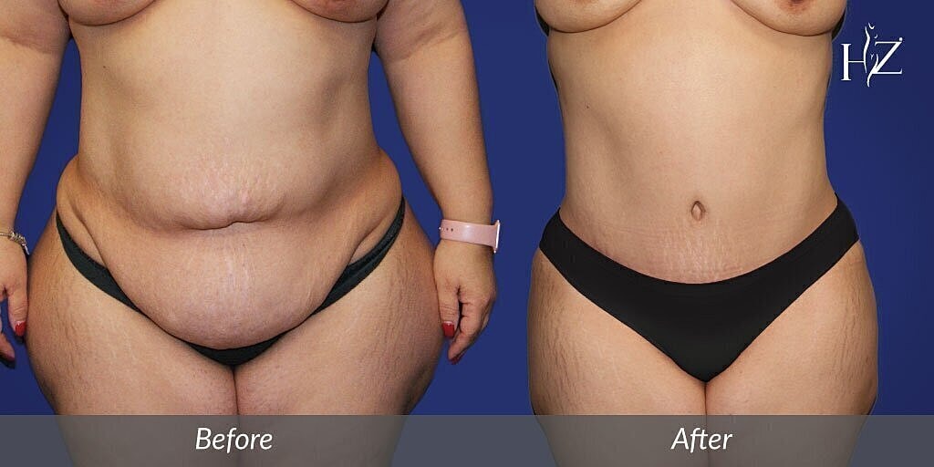 orlando tummy tuck before and after 1