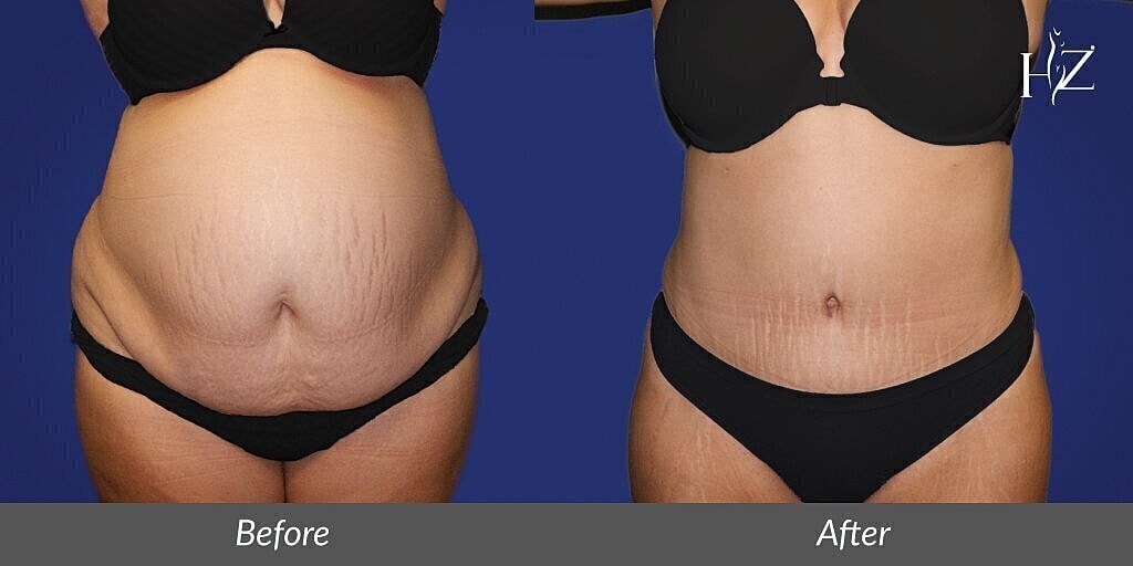 orlando tummy tuck before and after 2