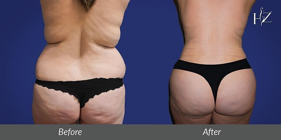 brazilian butt lift orlando, brazilian butt lift before and after 1