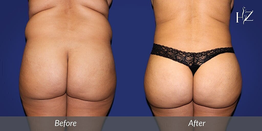 brazilian butt lift orlando, brazilian butt lift before and after 2