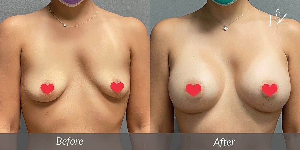 breast augmentation patient before and after 1
