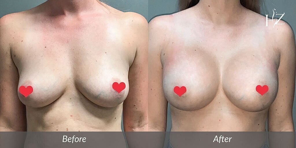 breast augmentation patient before and after 2