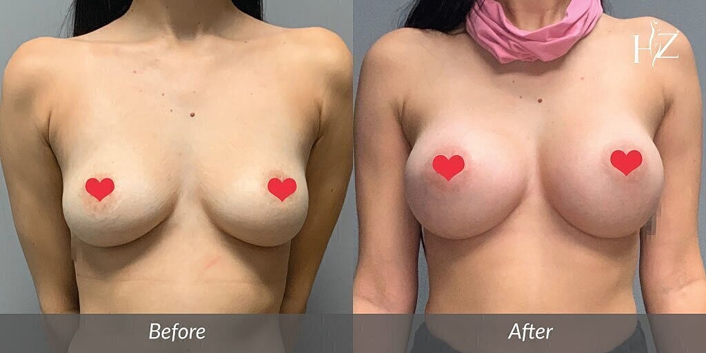 breast augmentation patient before and after 3