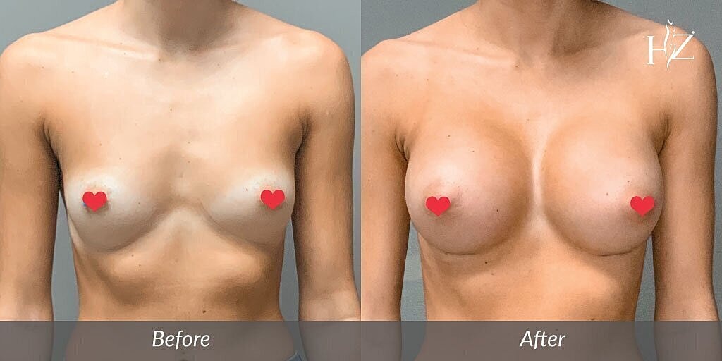 breast augmentation patient before and after 4