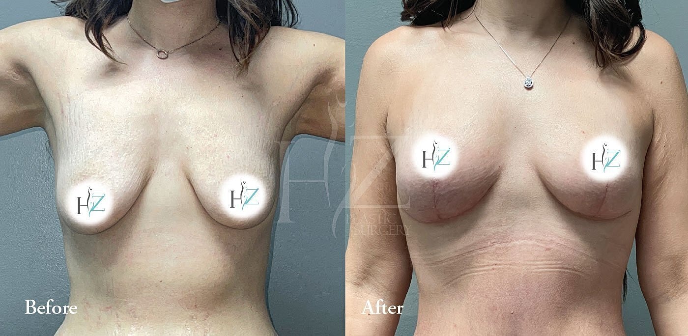 breast lift without implants patient before and after 1