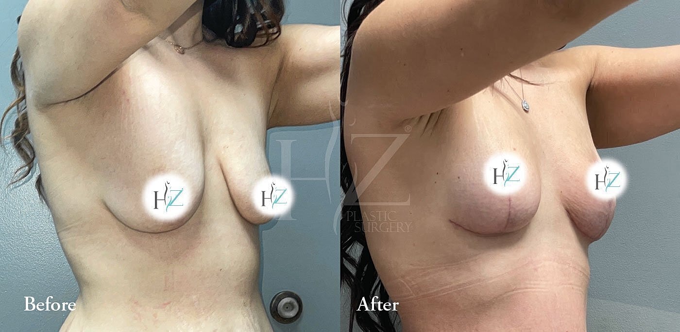 cbreast lift without implants patient before and after 2