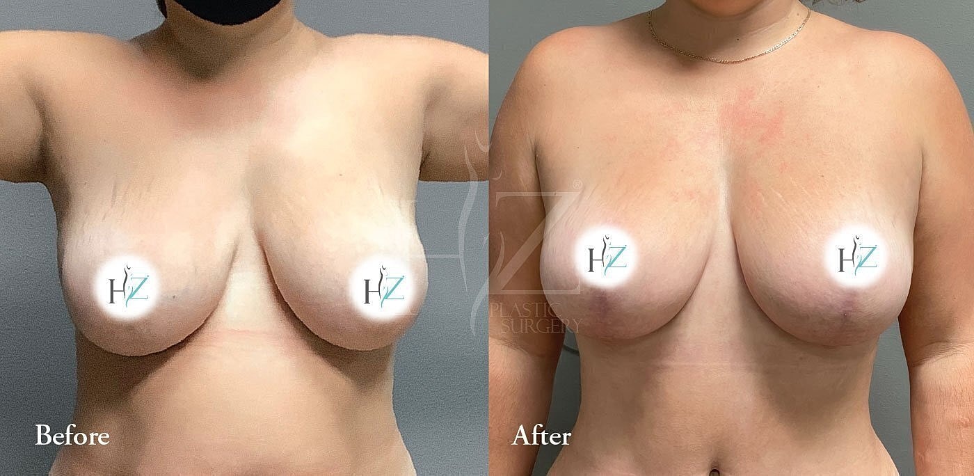 breast lift without implants patient before and after 3