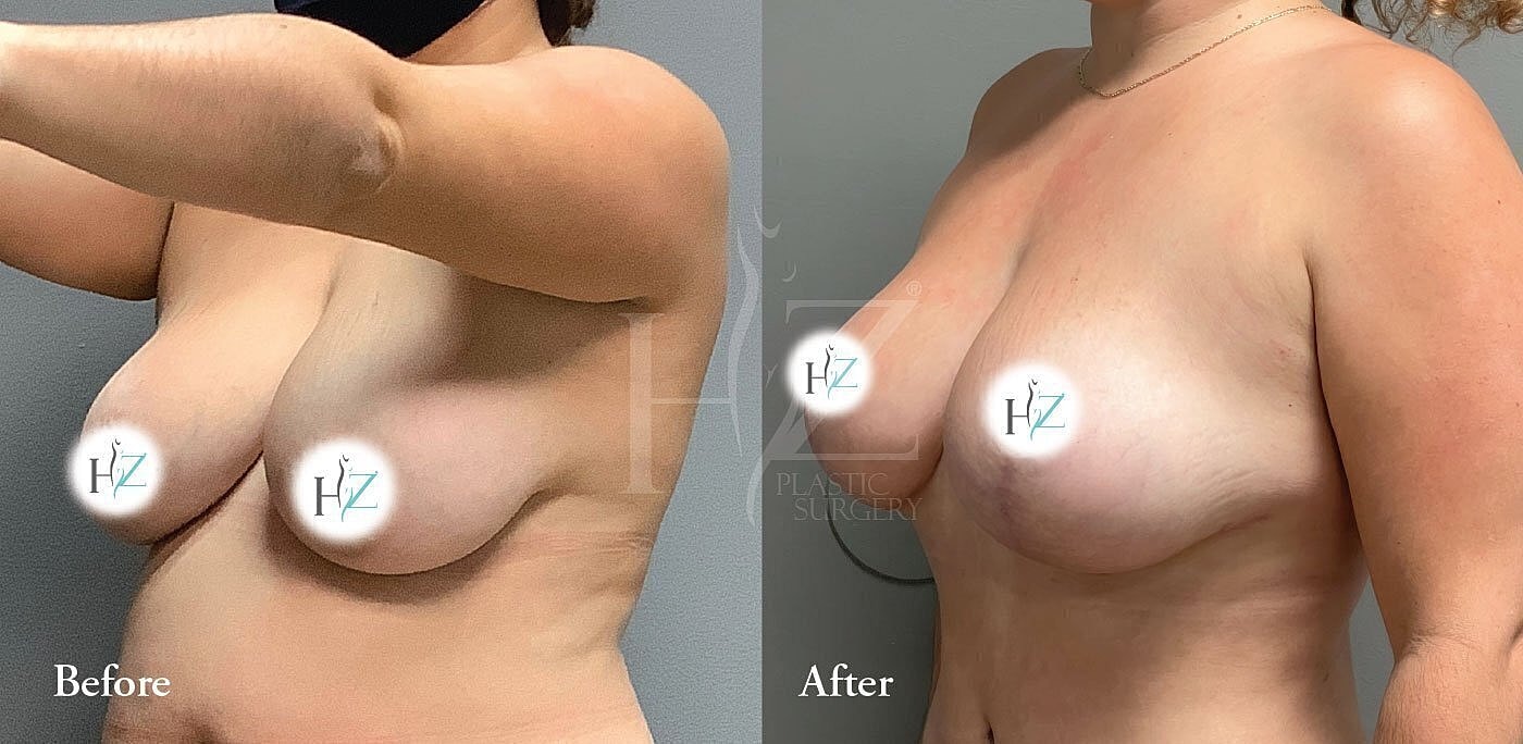 breast lift without implants patient before and after 4