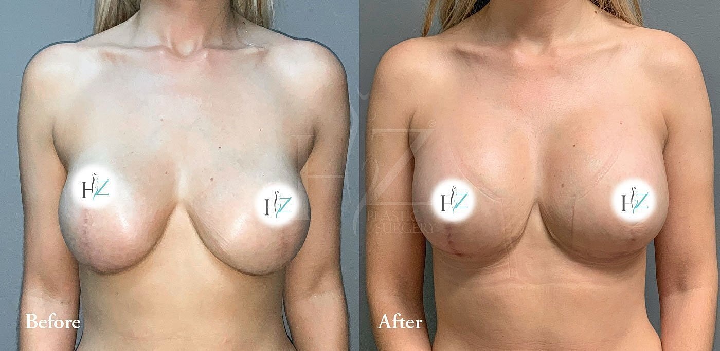 breast lift with implants or fat grafting before and after 1