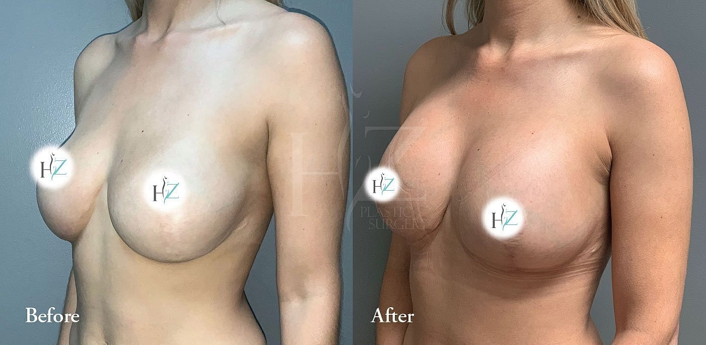breast lift with implants or fat grafting before and after 2
