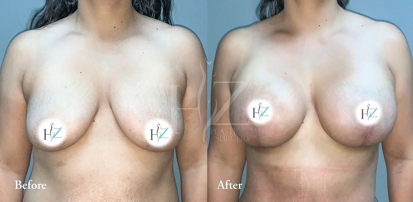 breast lift with implants or fat grafting before and after 3