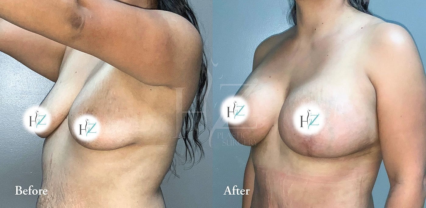 breast lift with implants or fat grafting before and after 4
