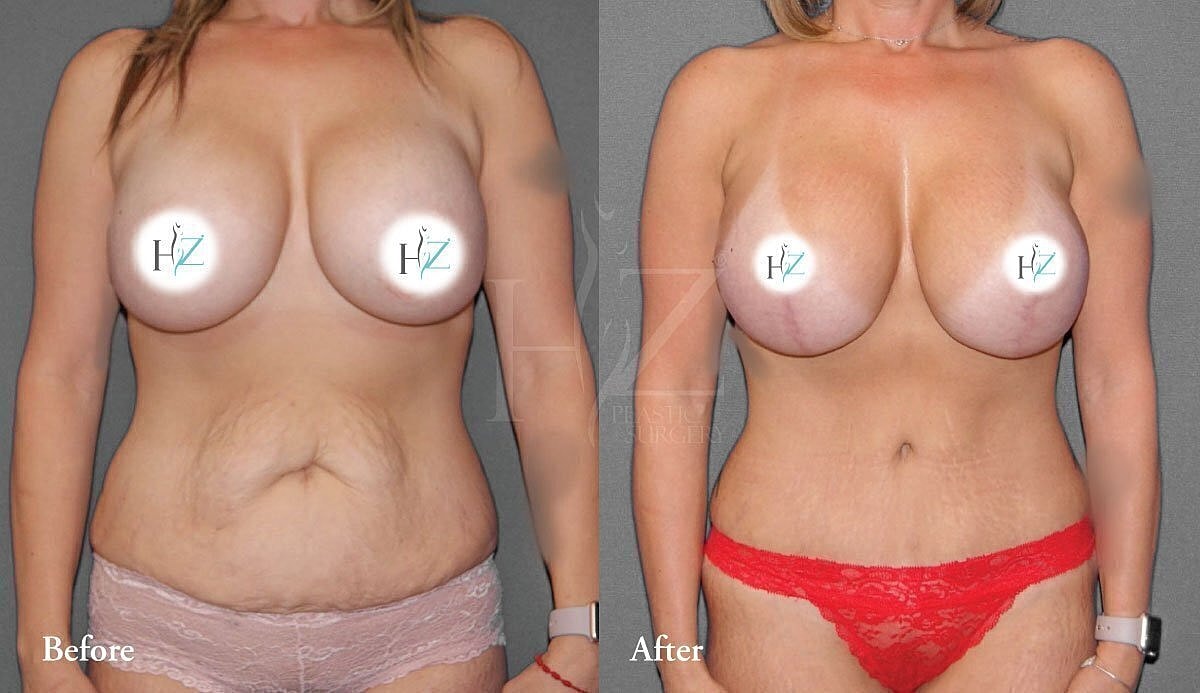 tummy tuck patient before and after 3