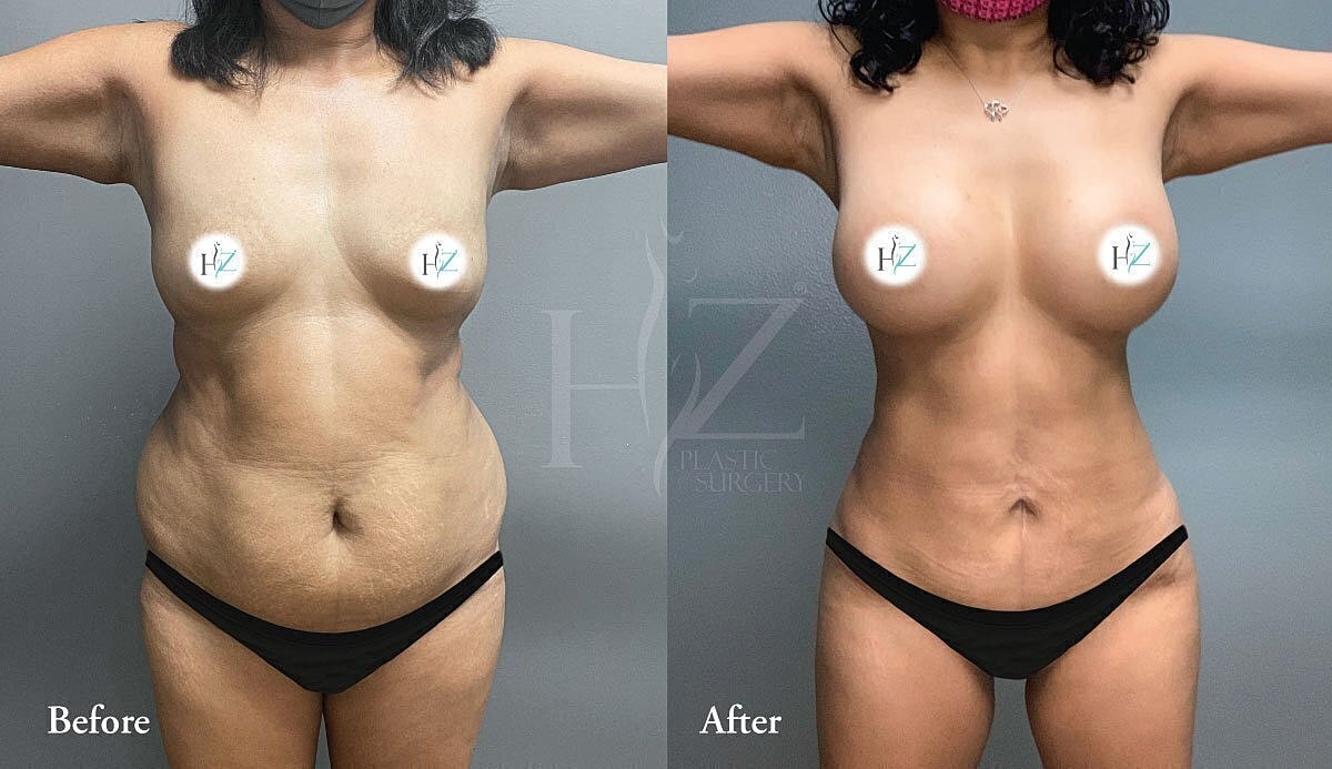 mommy makeover patient before and after 4