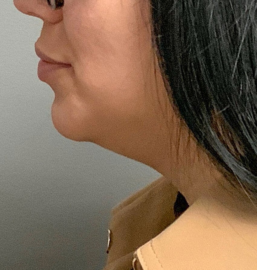 kybella patient before