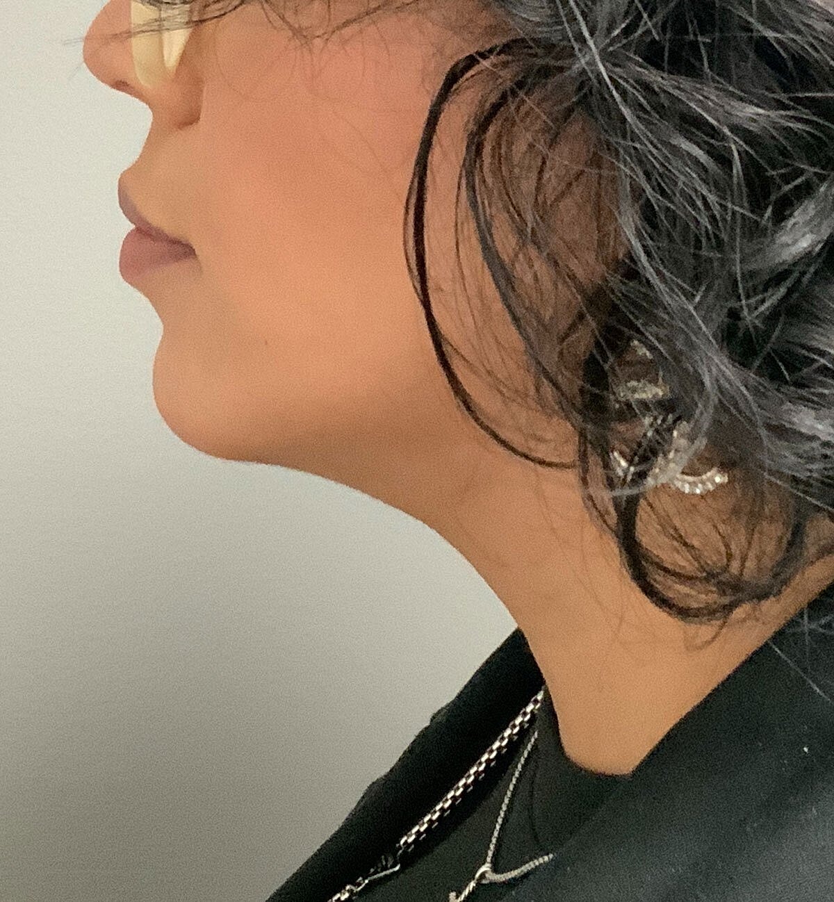 kybella patient after photo 1