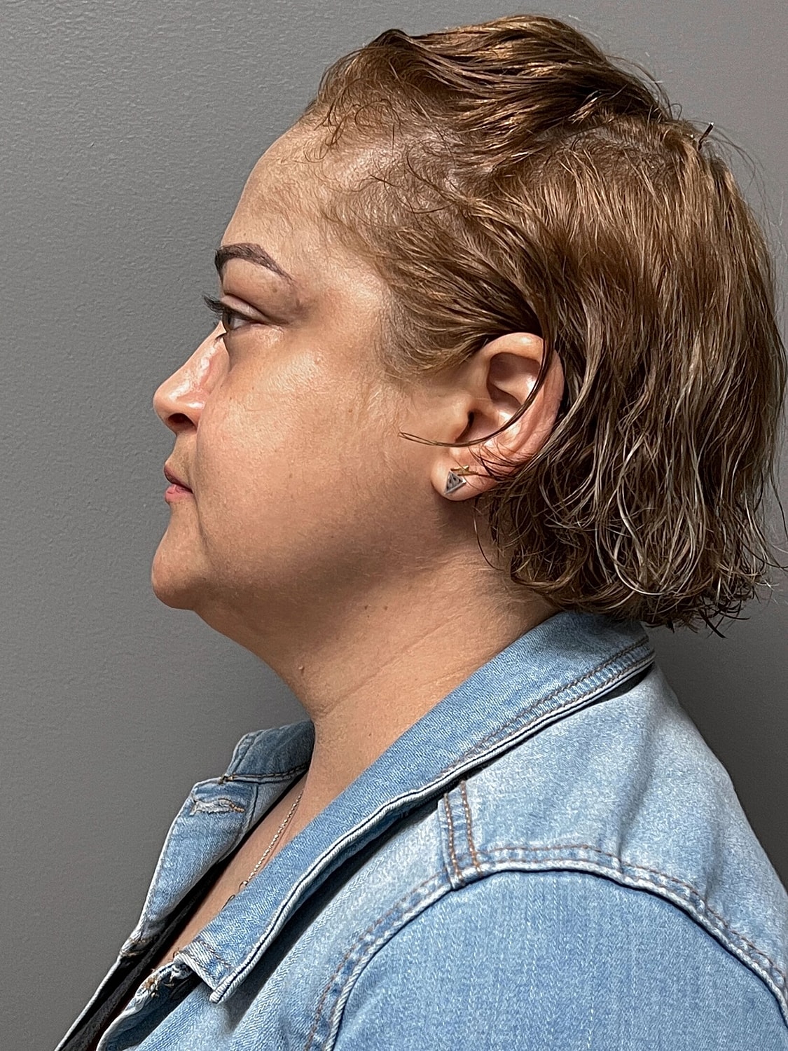 kybella patient before photo 3
