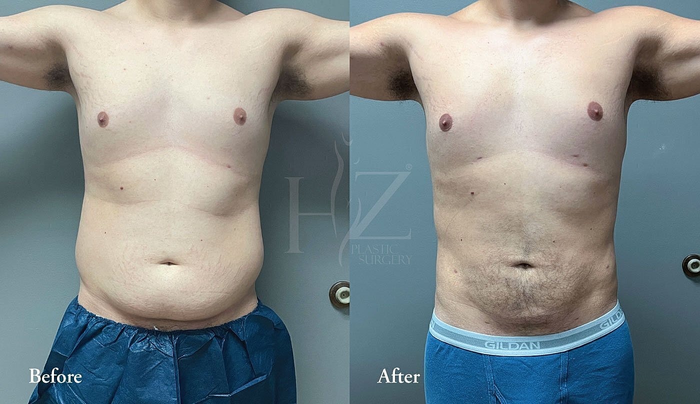 liposuction patient before and after 1