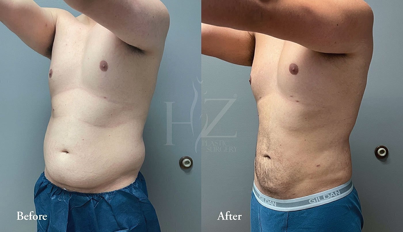 liposuction patient before and after 2
