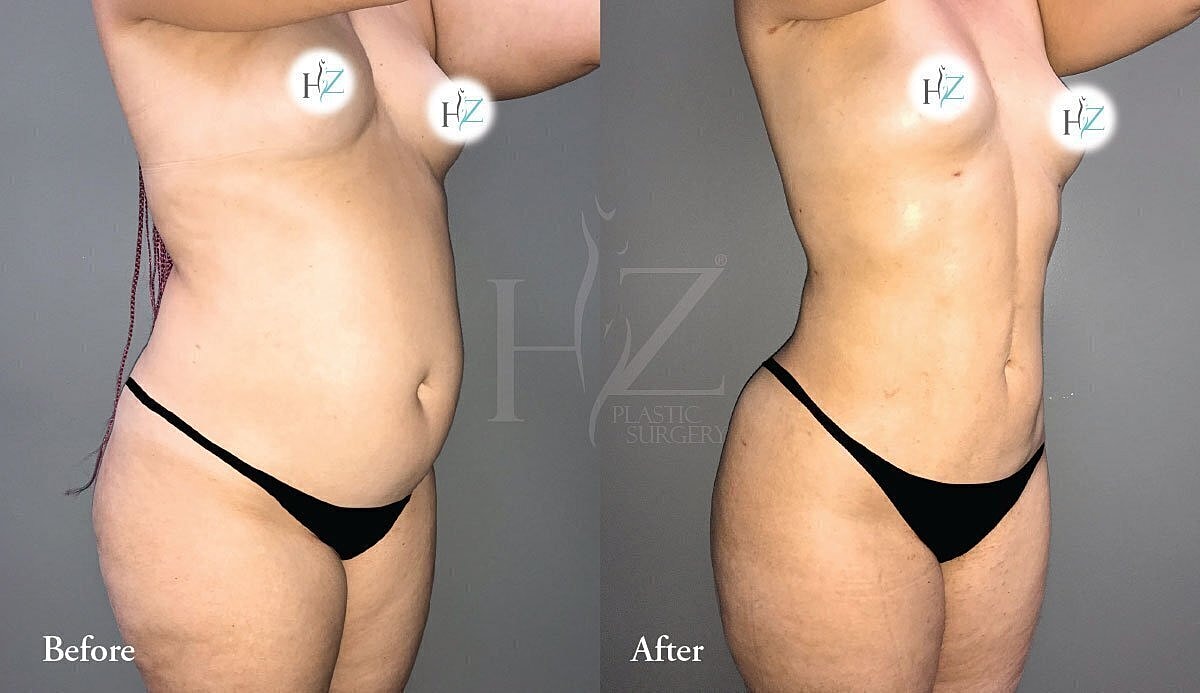 liposuction patient before and after 4