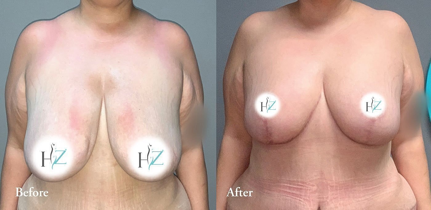breast reduction patient before and after 5