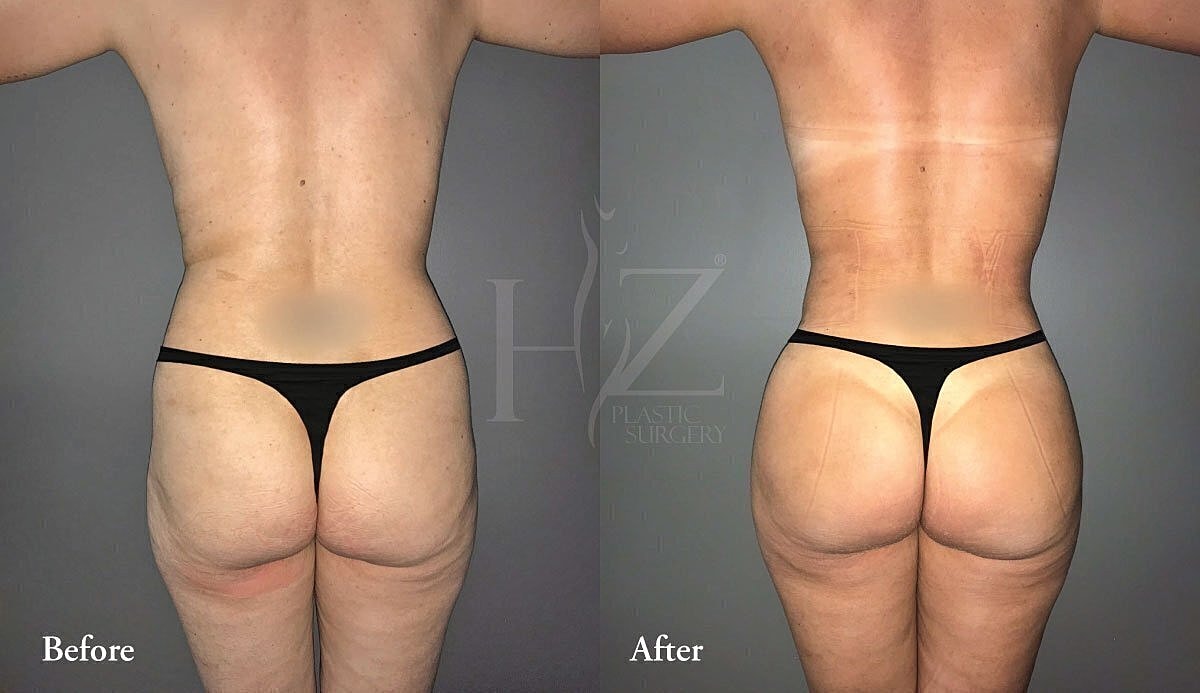 brazilian butt lift patient before and after 1