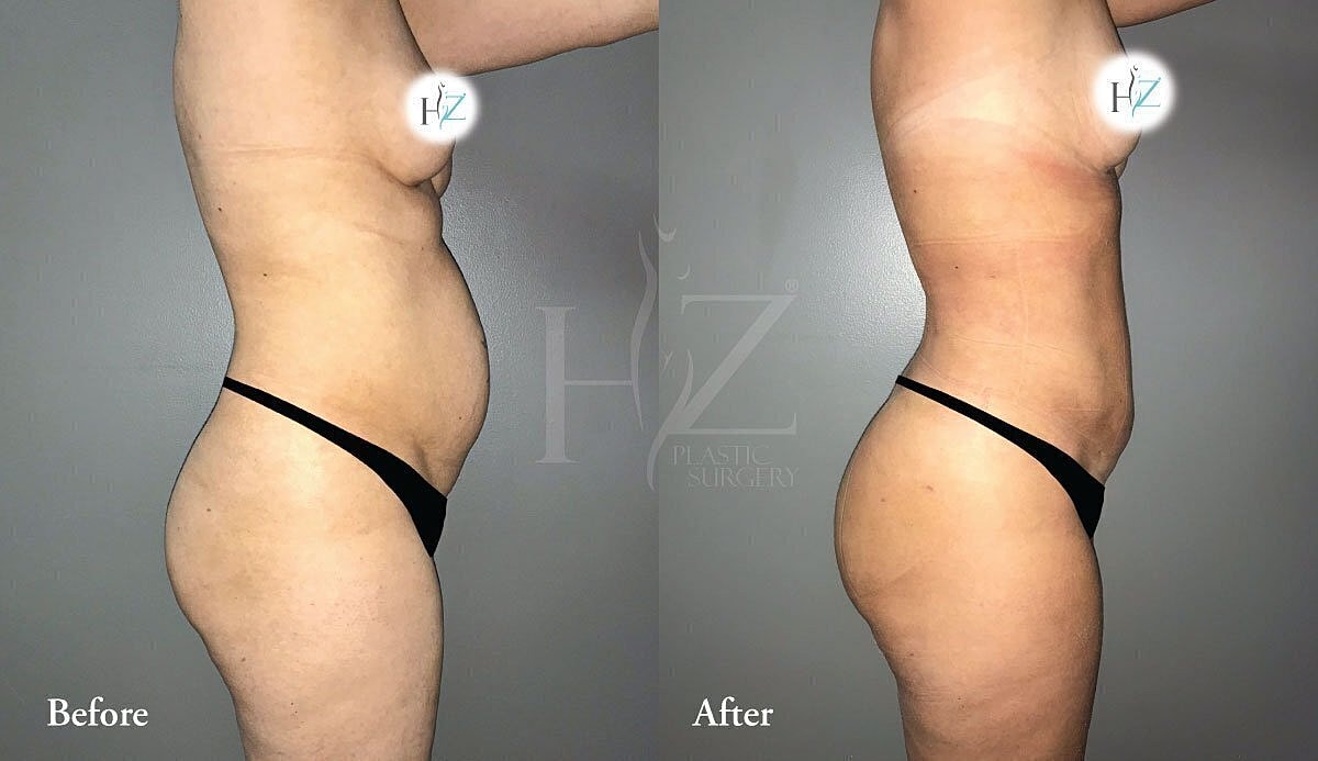 brazilian butt lift patient before and after 2
